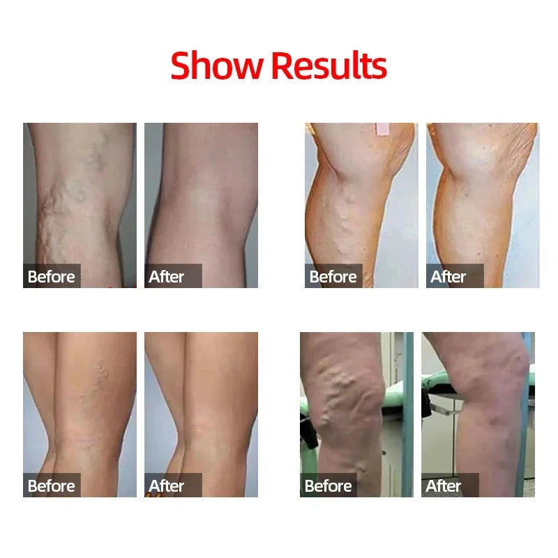 Compression Calf Sleeves – 20-30mmHg Shin Support for Running and Athletics